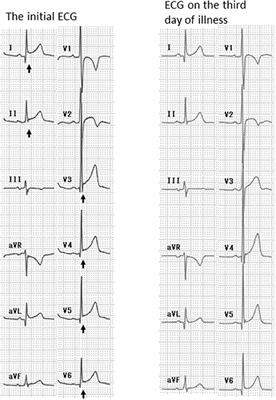 Case report: Five patients with myocarditis after mRNA COVID-19 vaccination